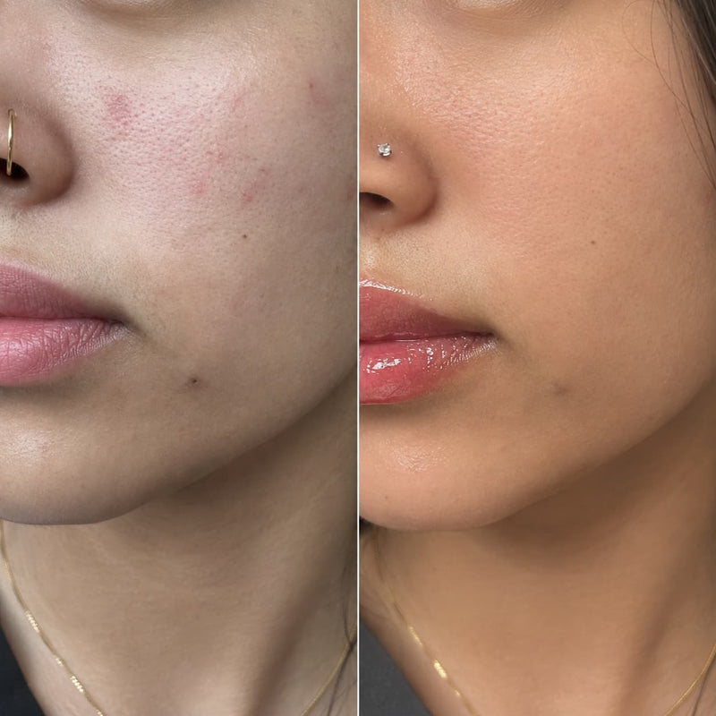 A close-up before-and-after split comparison of a woman's cheek and mouth area, showing acne and redness on the left and clearer, smoother skin on the right.