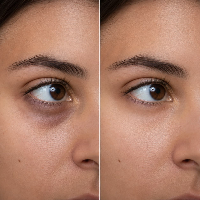 A close-up before-and-after comparison of a woman's eye area, showing under-eye darkness and puffiness on the left and a smoother, brighter result on the right.